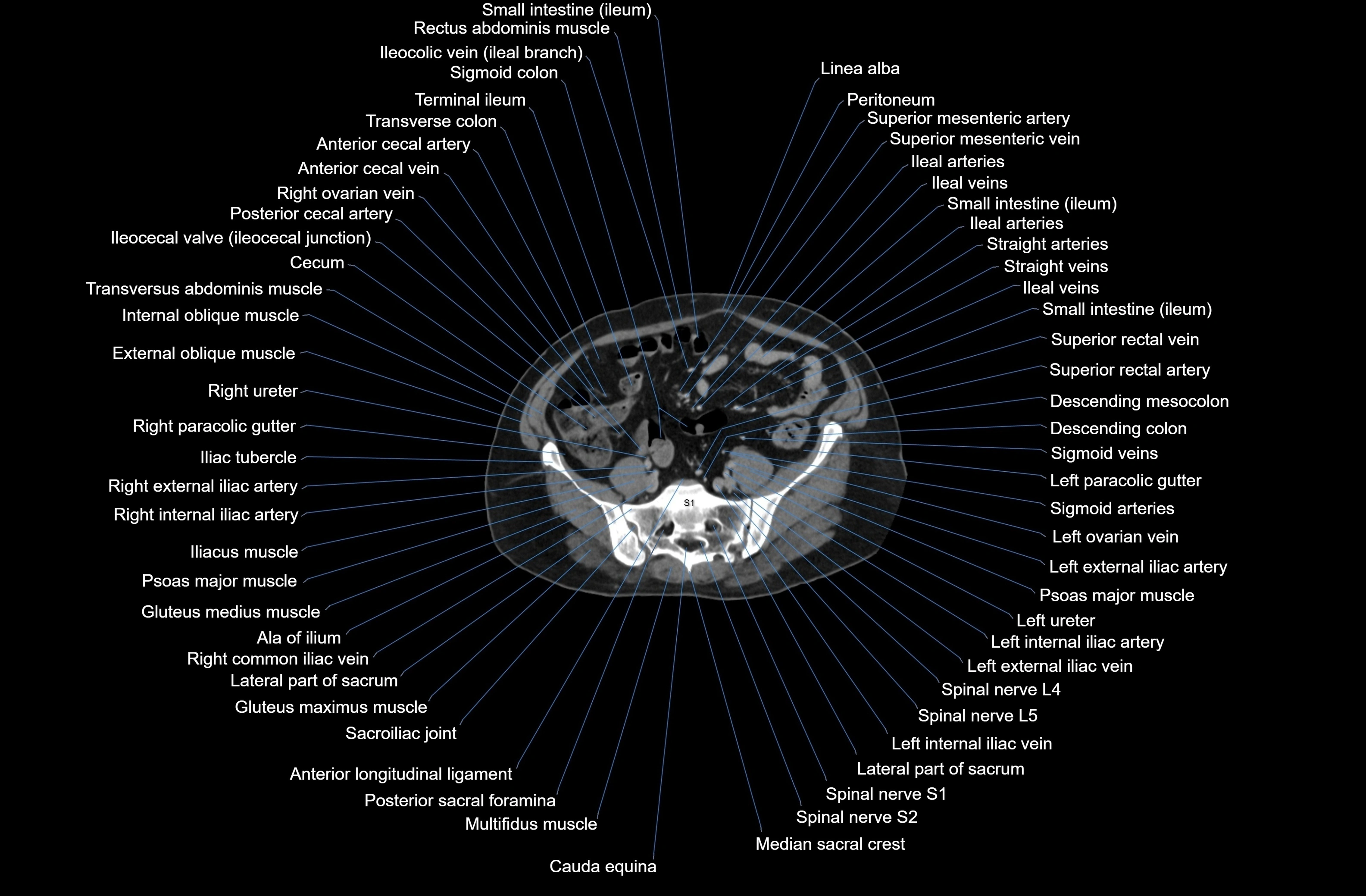 CT Abdomen axial cross sectional anatomy labelled radiology image-00067.webp